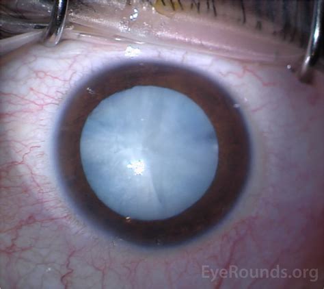 EyeRounds.org: Diabetic White Cataract