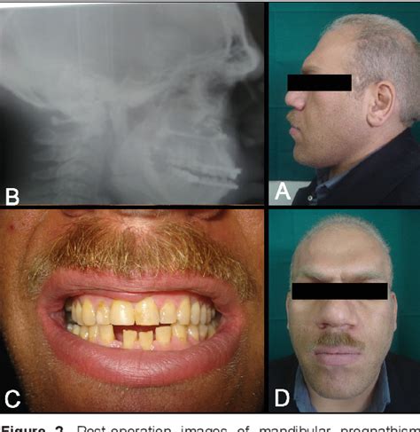 Mandibular Prognathism Before After