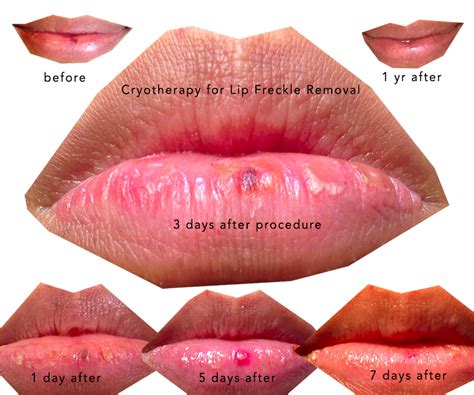 My Lip Freckle Removal Story