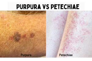 Petechiae vs. Purpura vs. Ecchymosis: Causes and Treatment