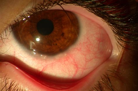 Vernal keratoconjunctivitis (VKC) | www.ocular-surface.org