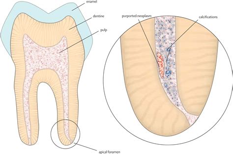 Teeth: malignant neoplasms in the dental pulp? - The Lancet Oncology