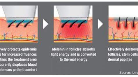 laser hair removal san antonio cost - Svetlana Meador