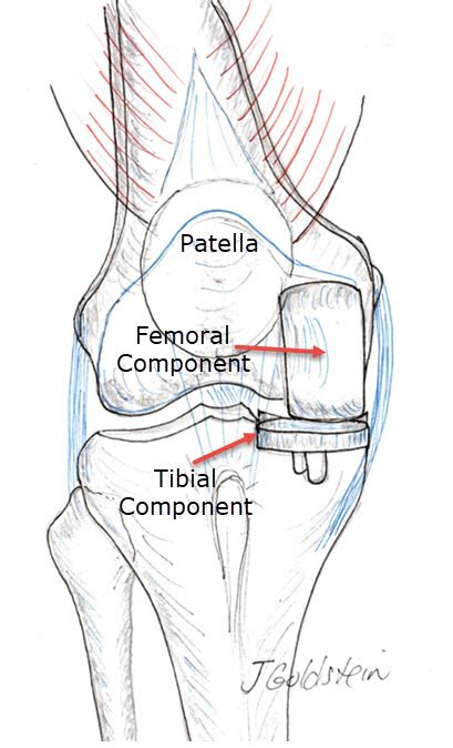 Unicondylar Knee Replacement – Sports Medicine and Orthopedics