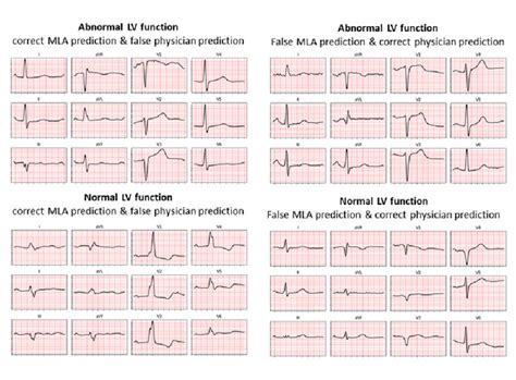 ECG examples of discordant diagnosis of normal/abnormal left ...