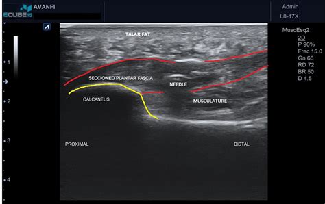 Ultrasound Treatment For Plantar Fasciitis : Hallux rigidus | Causes and treatment options ...