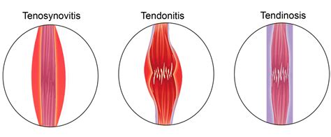 Suffering from Tendinopathy or Achilles Tendonitis: Learn all your options