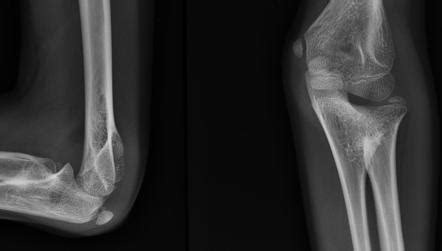 Proximal radioulnar synostosis | Image | Radiopaedia.org