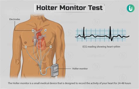 Holter Monitor Test: Procedure, Purpose, Results, Cost, Price, Online booking