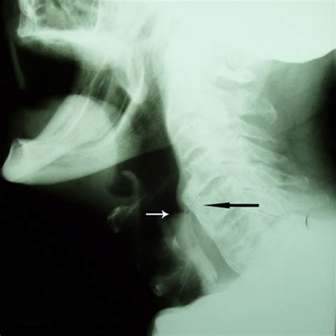 Dysphagia due to anterior cervical osteophytes complicated with ...