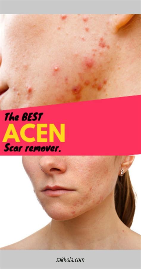 Nodular Acne: Causes Treatments And Prevention – EadvVienna2020.org