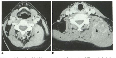 Figure 1 from Levator scapulae muscle asymmetry presenting as a palpable neck mass: CT ...