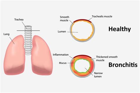 Bronchitis In Toddlers Treatment | Medical News Today