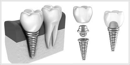 titanium-teeth-implant - The Glenroy Dental Group