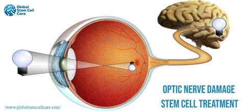 Optic nerve damage stem cell treatment – Artofit