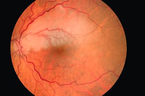 Acute retinal arterial occlusion after intravenous administration of ...