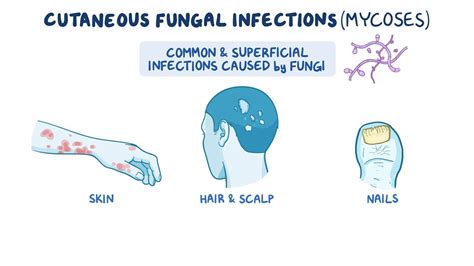 Cutaneous fungal infections: Nursing - Biblioteca de Osmosis