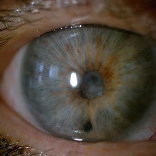 Cataract eye with posterior synechiae before (left) and after the... | Download Scientific Diagram