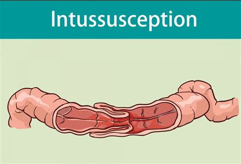 Complications of Intussusception