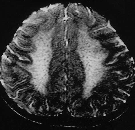 Leukodystrophy in Children: A Pictorial Review of MR Imaging Features | RadioGraphics