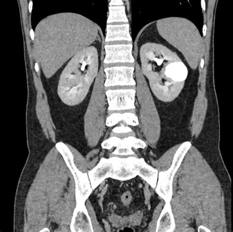 Calyceal diverticulum | Image | Radiopaedia.org