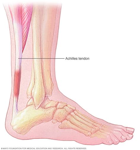 Achilles tendinitis - Symptoms and causes - Mayo Clinic