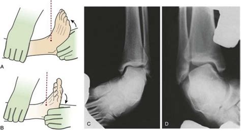 Pediatric Ankle Trauma Radiographic Evaluation - Pediatrics - Orthobullets