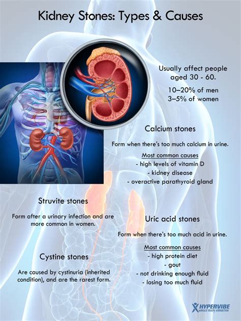 Types and causes of kidney stones #health #infographic #kidney #stones ...