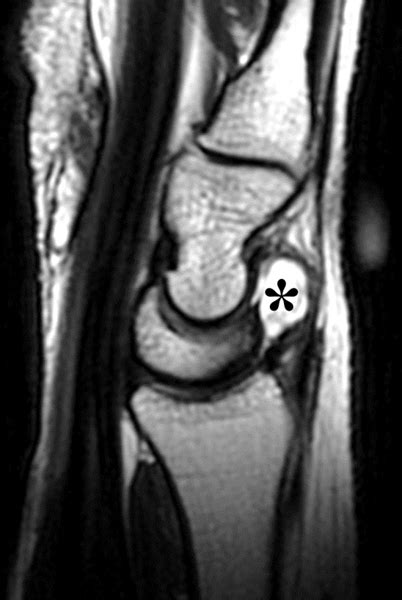 Wrist Ganglion Cysts | Radsource