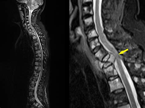 Cord compression - multiple myeloma - Radiology at St. Vincent's University Hospital