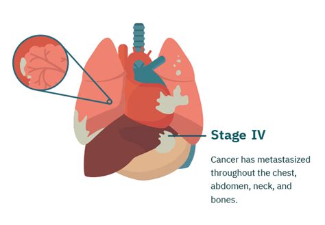 Stage 4 Mesothelioma | Treatment Options & Prognosis