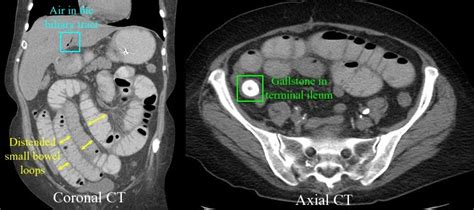 RadiologySpirit: Gallstone Ileus on CT Scans