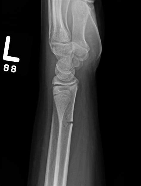 Greenstick fracture | Radiology Reference Article | Radiopaedia.org ...