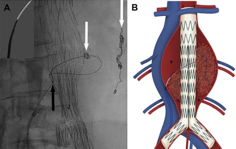 Figure 1 from Transcaval embolization as an alternative technique for ...