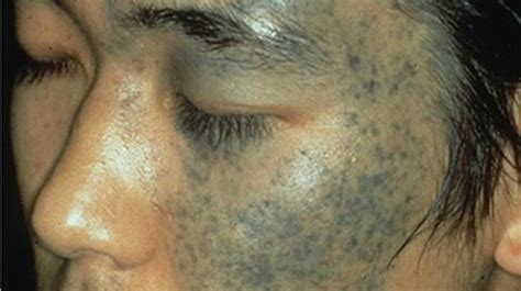 Nevus of Ota causes, symptoms, diagnosis & treatment