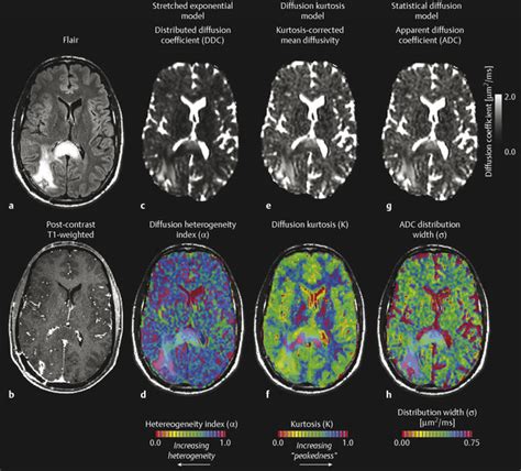 8 Diffusion-Weighted Imaging for Gliomas | Radiology Key