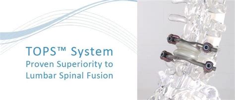 FDA approves IDE study for Premia Spine’s TOPS™ System | Ortho Spine News | Fda, Fda approved ...