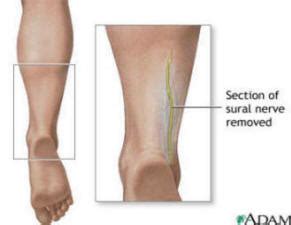 Sural Nerve Biopsy