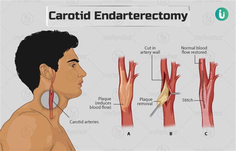 Carotid endarterectomy: Procedure, Purpose, Results, Cost, Price