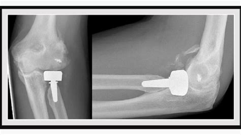 Press-Fit Radial Head Arthroplasty: Benefits and Risks