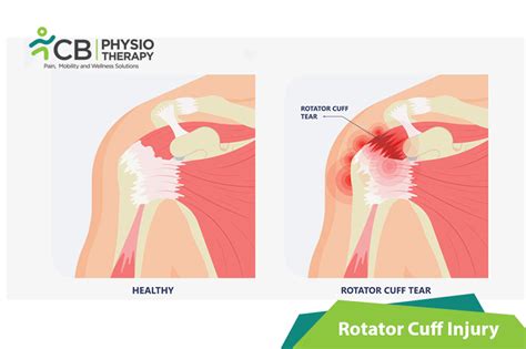 Rotator Cuff Injury Treatment Doctors in Hyderabad| Book Appointment / Consult Online with ...