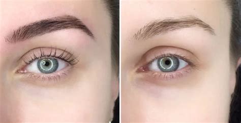 Eyeliner Tattoo Removal: Overcoming The Pain and Struggles