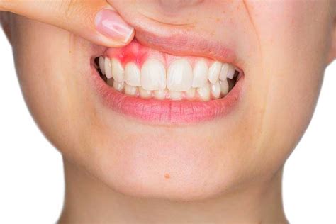 Tooth Cavities | Prevention, Symptoms & Treatments - Arcade Dental