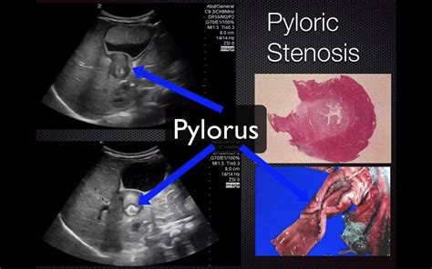 Finding the CBD - Ultrasound Troubleshoot | Issue finding the Common Bile Duct (CBD)? You are ...