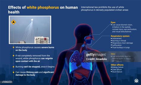 An infographic titled "Effects of white phosphorus on human health"... News Photo - Getty Images