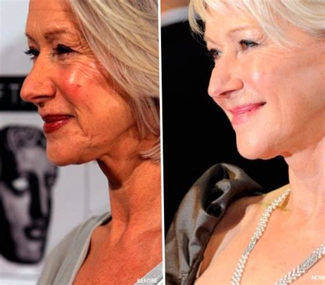 Helen Mirren before and after plastic surgery 06 – Celebrity plastic surgery online