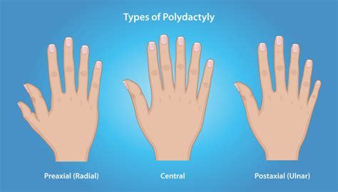 Polydactyly | International Center for Limb Lengthening