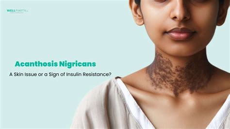 Acanthosis Nigricans: A Skin Issue or a Sign of Insulin Resistance ...