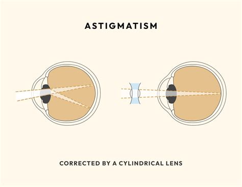 Glasses for Astigmatism Explained | Blog | Eyebuydirect