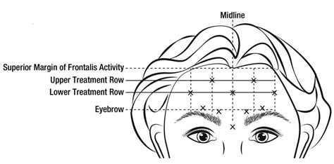 Botox Cosmetic Dosage Guide - Drugs.com